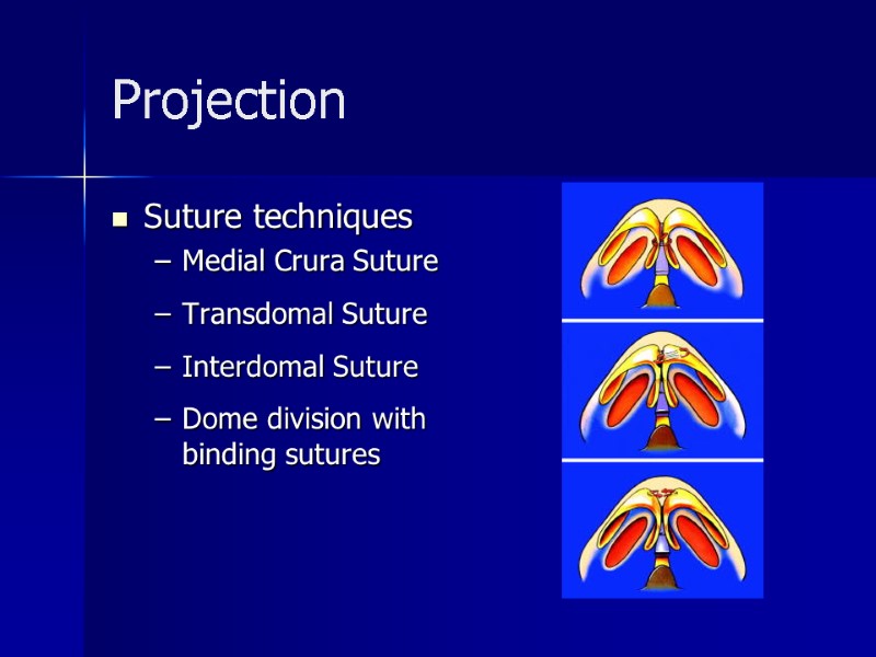Projection Suture techniques Medial Crura Suture  Transdomal Suture  Interdomal Suture  
